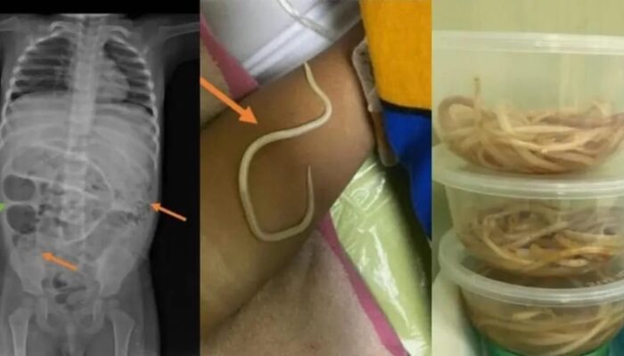 Pakar Parasitologi UM Surabaya Ungkap Penyebab Perut Anak di Jember Penuh Cacing