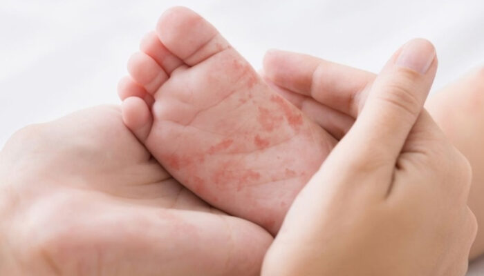 Waspada Campak! Dinkes Tulungagung Gelar Imunisasi Massal di Ringinpitu